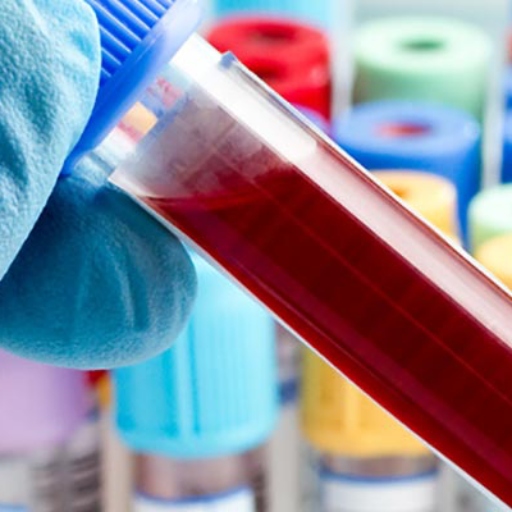 لوسمی لنفوسیتی مزمن (CLL)