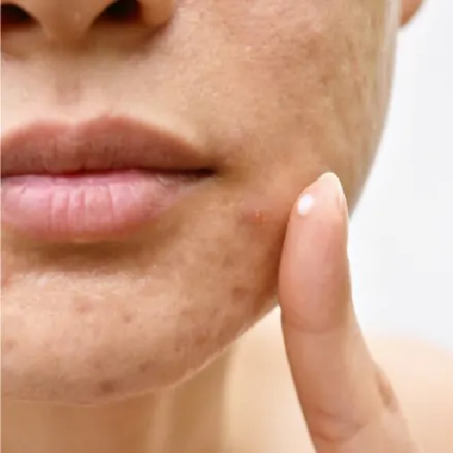 از بین بردن جای جوش