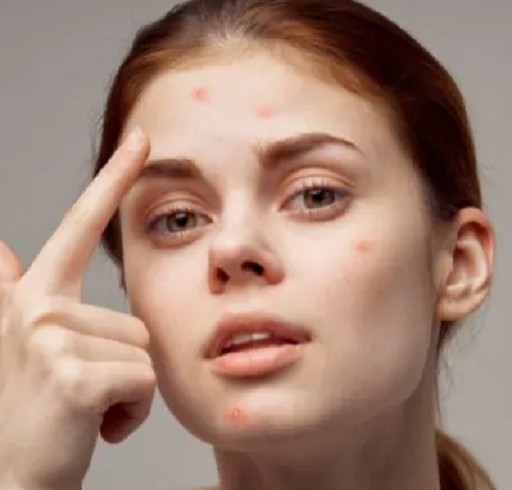 نبرد علیه جوش صورت؛ راهنمایی برای رسیدن به پوستی شفاف