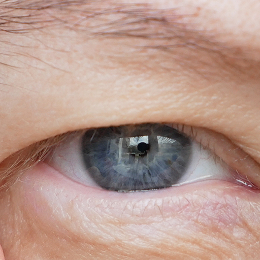 پتوزیس (Ptosis) یا افتادگی پلک چیست؟