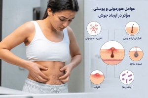 علت جوش روی شکم زنان؛ از تغییرات هورمونی تا بیماری‌های پوستی که نباید نادیده گرفت