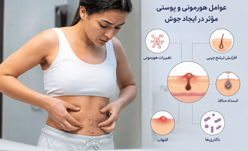 علت جوش روی شکم زنان؛ از تغییرات هورمونی تا بیماری‌های پوستی که نباید نادیده گرفت